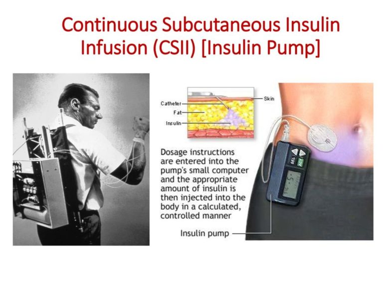 Reimbursement of Continuous Subcutaneous’ Insulin Infusion (CSII) Pump Therapy’ under CGHS/CS(MA) Rules, 1944 – Guidelines